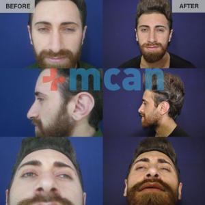 Before-After Rhinoplasty