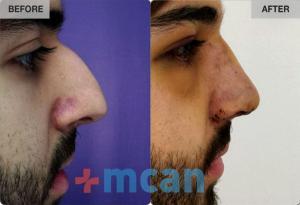 Before-After Rhinoplasty