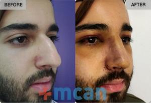 Before-After Rhinoplasty