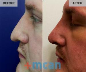 Before-After Rhinoplasty