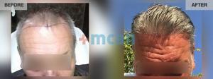 Hair Transplant - 4100 grafts - 7 months - MCAN Health