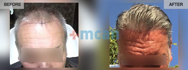 Trasplante capilar en Turquía con MCAN Health