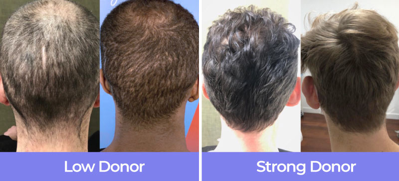 4 headshots of hair transplant donor areas, two head are low donor, two are strong donor areas