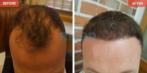 Hair Transplant Turkey Before After