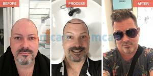 Hair Transplant Turkey - Before After - MCAN Health