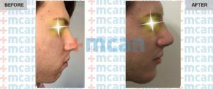 Chin Implant Turkey Before After - MCAN Health 01