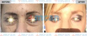 Eyelid Surgery Turkey Before After - MCAN Health 01
