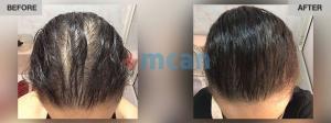 Female Hair Transplantation Before After - MCAN Health 01