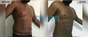 Gynecomasty Turkey Before After - MCAN Health 01