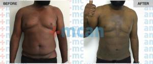Gynecomasty Turkey Before After - MCAN Health 02
