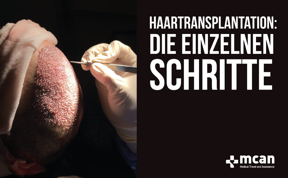 Haartransplantation: Die einzelnen Schritte