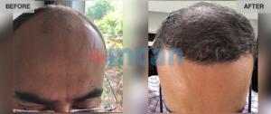 Hair Transplant Turkey Before After - MCAN Health 01
