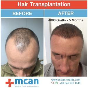 Hair Transplant Turkey Before After - MCAN Health 04