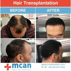 Hair Transplant Turkey Before After - MCAN Health 05