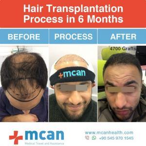 Hair Transplant Turkey Before After - MCAN Health 06