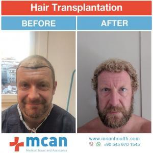 Hair Transplant Turkey Before After - MCAN Health 07
