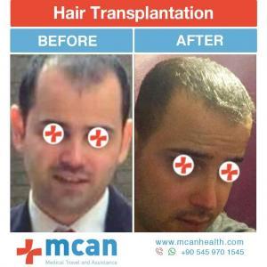 Hair Transplant Turkey Before After - MCAN Health 08