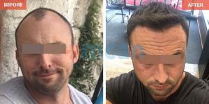 Hair Transplant Turkey Before After - MCAN Health 09