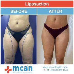 Liposuction Turkey Before After - MCAN Health