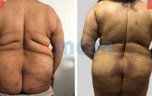 Liposuction Turkey Before After - MCAN Health 02