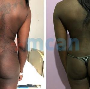Liposuction Turkey Before After - MCAN Health 03
