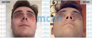 Rhinoplasty Turkey Before After - MCAN Health