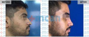 Rhinoplasty Turkey Before After - MCAN Health 02