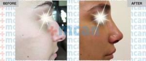 Rhinoplasty Turkey Before After - MCAN Health 03
