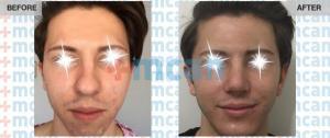 Rhinoplasty Turkey Before After - MCAN Health 04