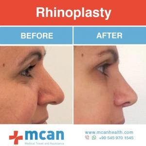 Rhinoplasty Turkey Before After - MCAN Health 06