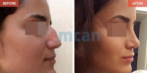 Rhinoplasty Turkey Before After - MCAN Health 07