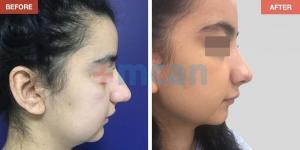 Rhinoplasty Turkey Before After - MCAN Health 08
