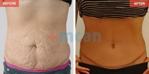 Tummy Tuck Turkey Before After - MCAN Health - 02