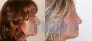 Before-After Affordable Rhinoplasty In Turkey | Nose Job in Turkey | MCAN Health Before-After