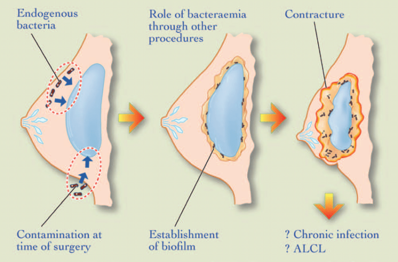 Breast implant Capsular Contracture