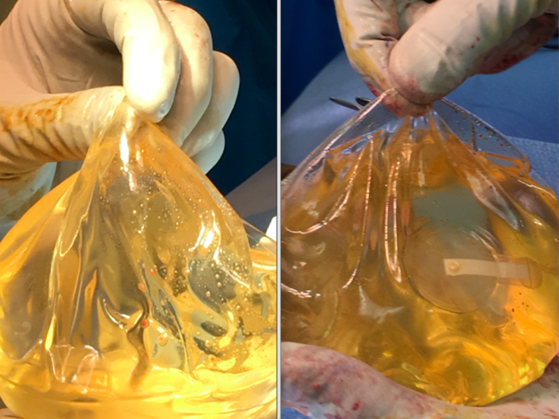 breast implant removal 