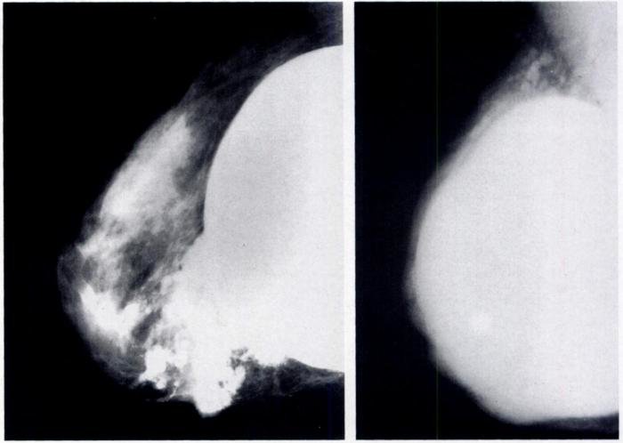 breast implant rupture