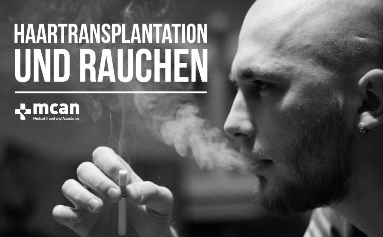 Haartransplantation und Rauchen 12 Haartransplantation und Rauchen 1 Haartransplantation und Rauchen