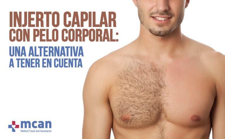 Injerto capilar con pelo corporal: una alternativa a tener en cuenta 6 Injerto capilar Injerto capilar