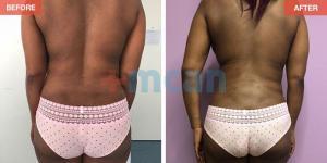 LiposuctionTurkey Before After - MCAN Health 02