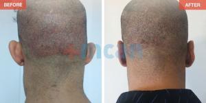 Otoplasty Turkey Before After - MCAN Health 08