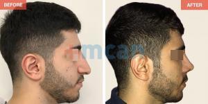 Rhinoplasty Turkey Before After - MCAN Health 09