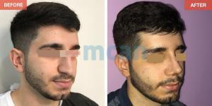 Rhinoplasty Turkey Before After - MCAN Health 10