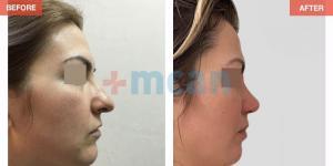 Rhinoplasty Turkey Before After - MCAN Health 11