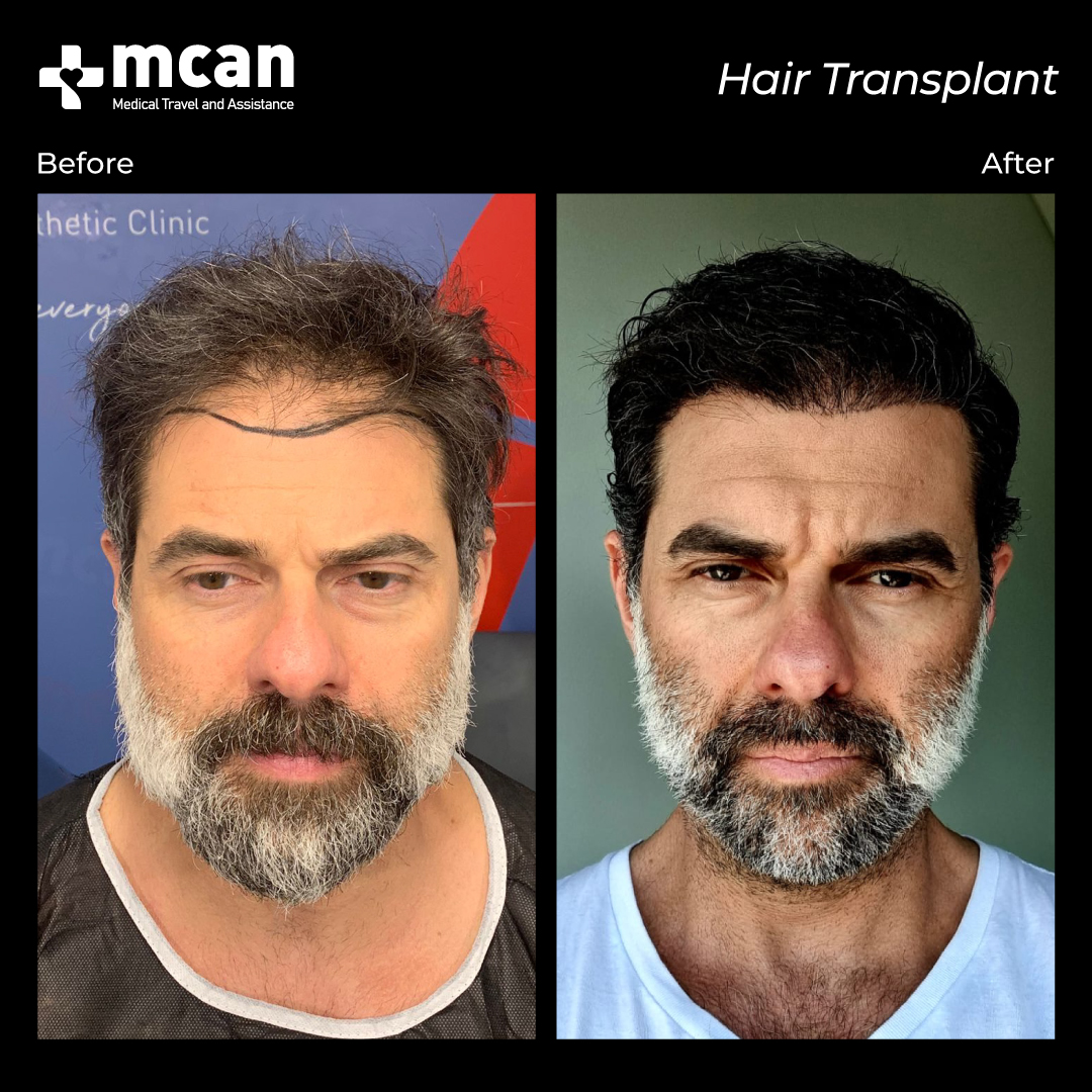 Candidato ideal para el trasplante capilar en Turquía | MCAN Health