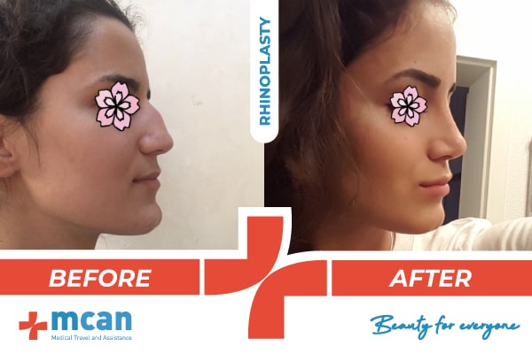 Plastic Surgery Turkey Before After Banner