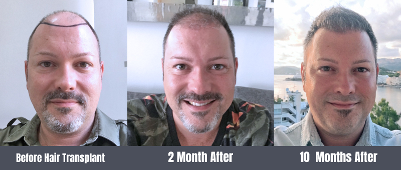 Haircut after FUE hair transplant