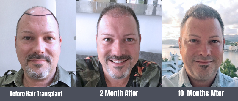 When Can I Get a Haircut After Hair Transplant? 3 New Project 1 Haircut after FUE hair transplant