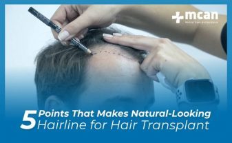 5 Points That Makes A Natural Looking Hairline For Hair Transplant