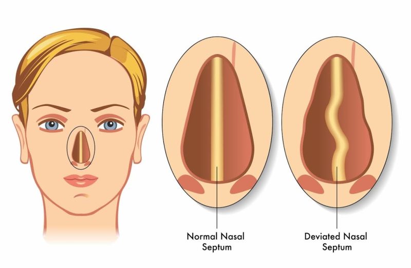 Nasal septum surgery